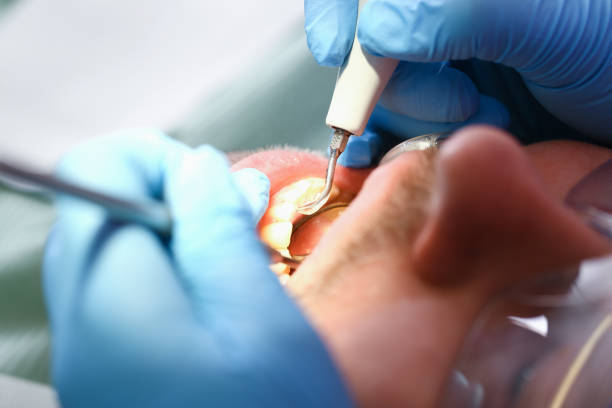 Best Emergency Dental Care for Broken or Chipped Teeth in Avenel, NJ